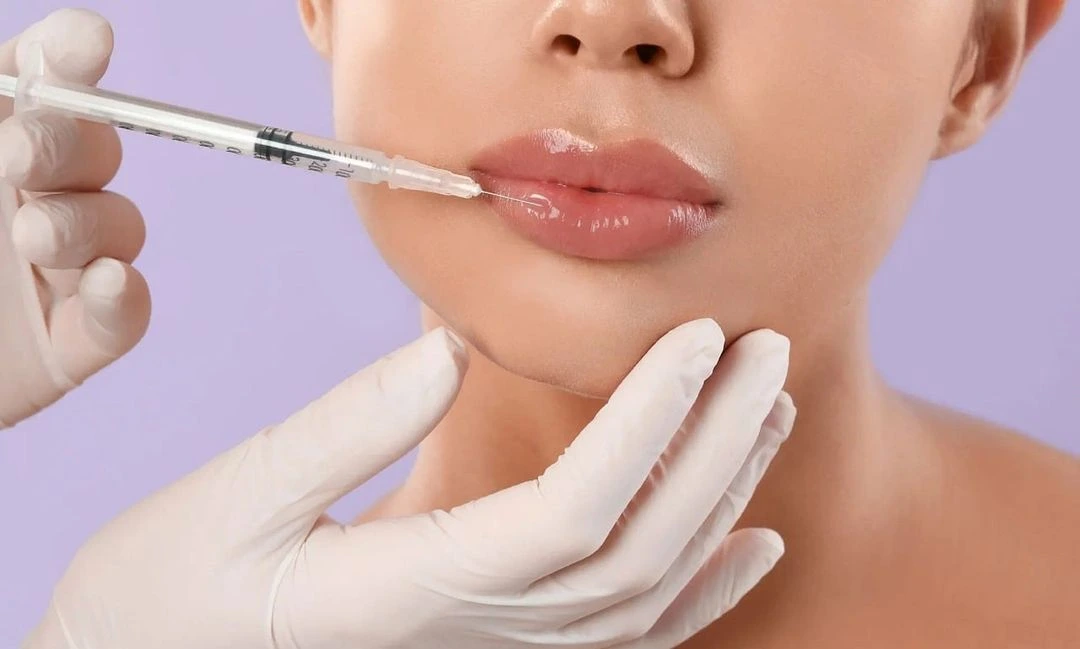 client receiving lip fillers